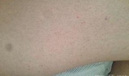 紫癜可以吃方瓜吗,方瓜的适宜与禁忌