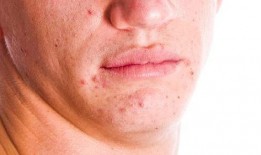 紫癜可以吃方瓜吗,方瓜的适宜与禁忌