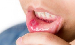 口腔溃疡吃哈密瓜疼