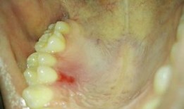 吃伊丽莎白瓜上牙膛痒,舌尖上的痒意之旅