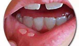 口腔溃疡吃哈密瓜疼