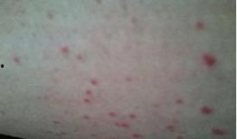 紫癜可以吃方瓜吗,方瓜的适宜与禁忌